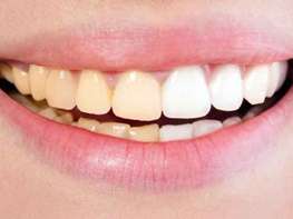 دندان‌های سفید، شفاف و براق، استحکام و سلامت کم‌تری دارند