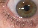 عفونت‌های ویروسی «چشم» شایع شده است